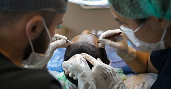 kosten haartransplantatie